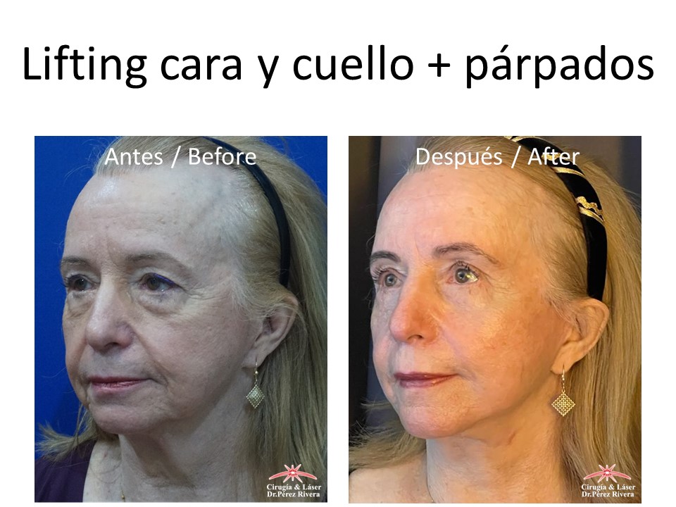 Antes y después