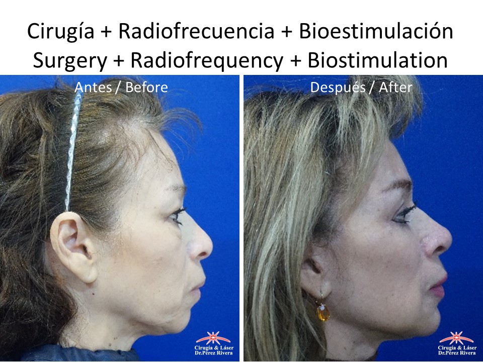 Antes y después