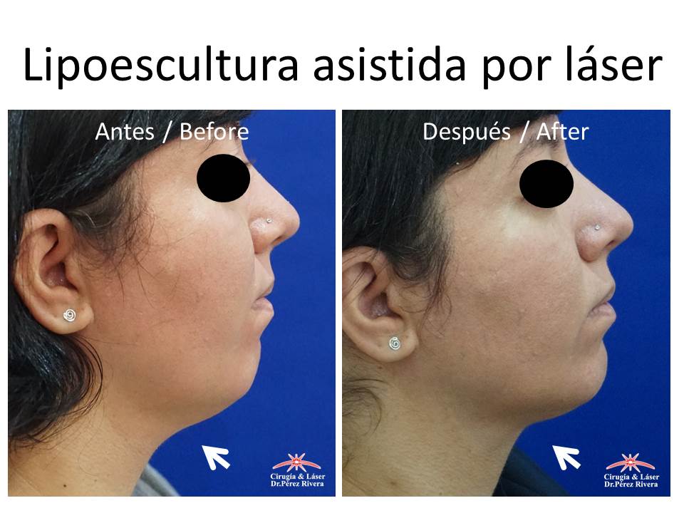 Antes y después