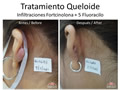 queloides y cicatrices