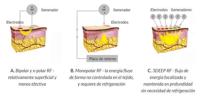 como funciona endymed