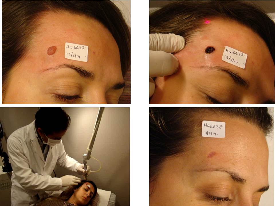 cirugia laser