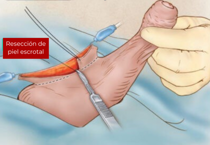 escrotoplastia