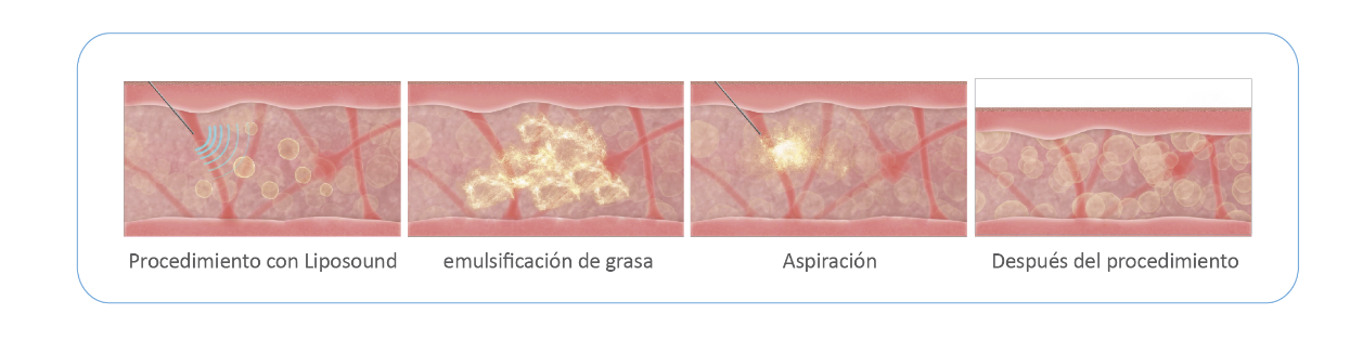 Lipoescultura con Liposound