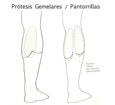 Prótesis gemelares