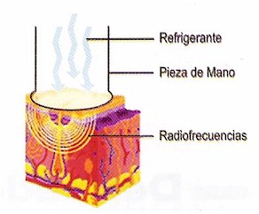 radiofrecuencia