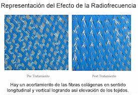 radiofrecuencia