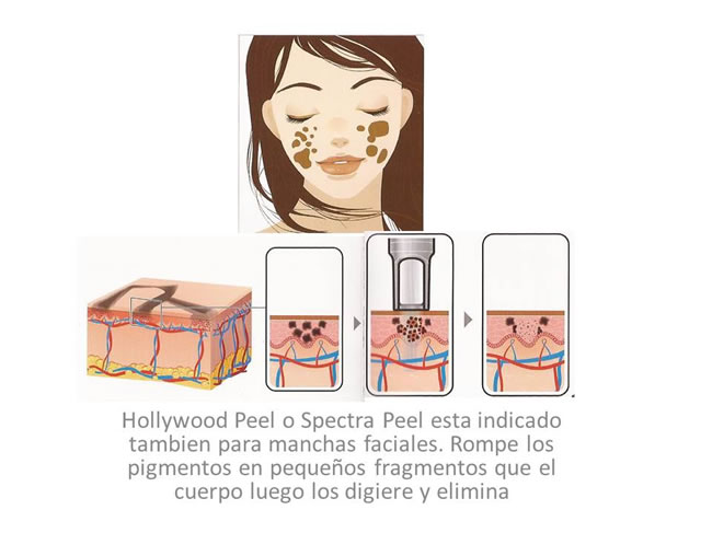 Spectra Peel